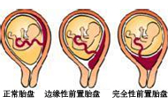 前置胎盤分哪幾種？有什么癥狀？